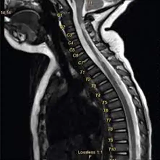 mri cervical dorsal scan